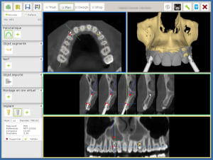 Implants canines 1 bdrsxi - Eugenol