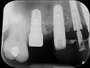 Implants db5nx7 - Eugenol