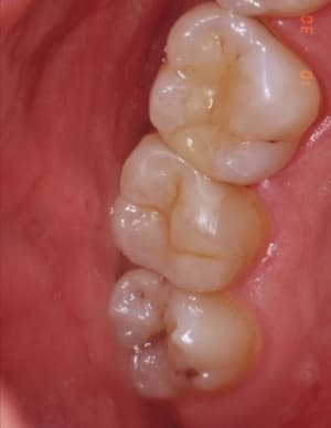 Inlay 2 rclrqc - Eugenol