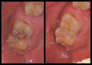 Inlay cerec tbuvrv - Eugenol