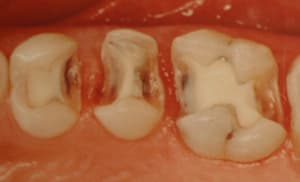 Inlay composite x5ssgc - Eugenol
