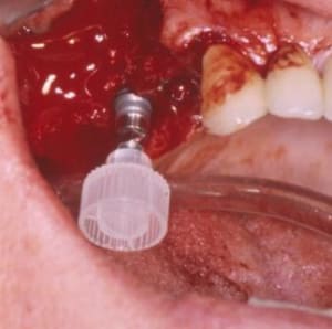 Insertion manuelle oqevht - Eugenol