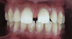 Intrabuccal auxlvk - Eugenol