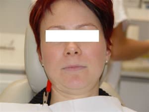Isa début de traitement ltgj0n - Eugenol