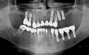 Kyste implant iewzdt - Eugenol
