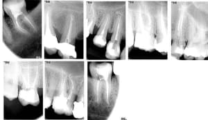 Laser ivbone - Eugenol