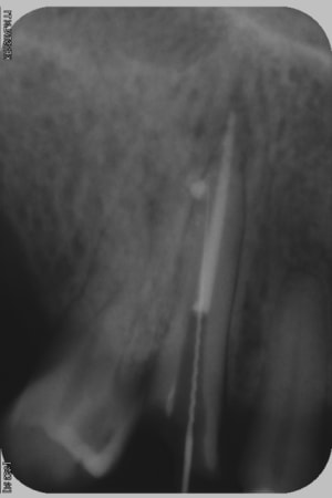 Le drame oejrl5 - Eugenol