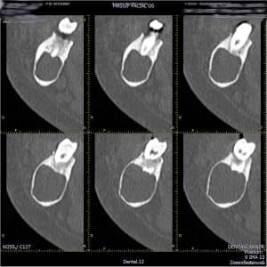 Mandibule  013 iosuoo - Eugenol