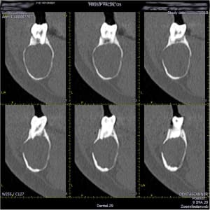 Mandibule  029 fad1m0 - Eugenol