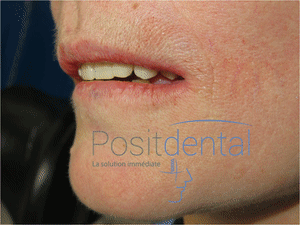 Mise en charge immédiate - Eugenol