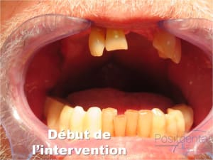 Mise en charge immédiate   implant tov  positdental 004 ru6if0 - Eugenol