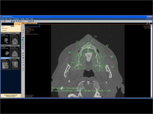 Mise en charge imm diate   expansion osseuse 001 lkvviw - Eugenol