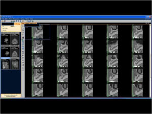 Mise en charge imm diate   expansion osseuse 003 uijvwh - Eugenol