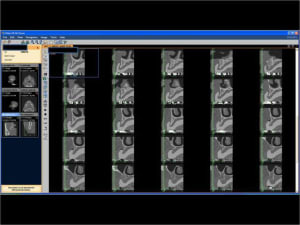 Mise en charge imm diate   expansion osseuse 004 cr7p8g - Eugenol
