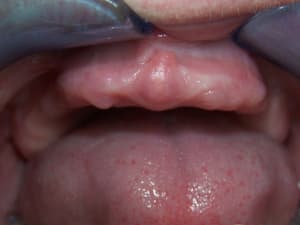 Mise en charge imm diate   expansion osseuse 010 cbb6tu - Eugenol