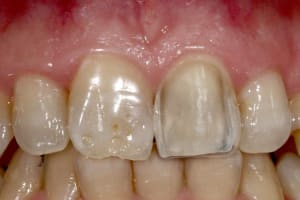 Montage dmfdsl - Eugenol