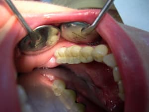 Occlusal k7zh05 - Eugenol