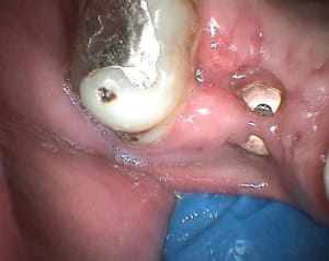 Operculisation mzug6r - Eugenol