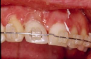 Ortho imp 2 hmbaph - Eugenol