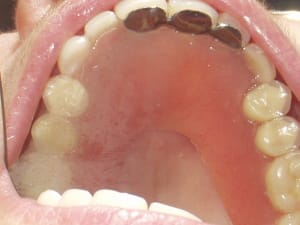 Overdenture 1 iun5fu - Eugenol