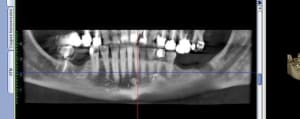 Pano implant g1btrh - Eugenol