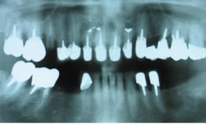 Pano implant tyibti - Eugenol