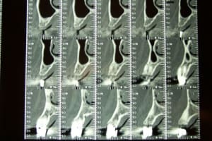 Photo avant apres scan coupe 36 xewgku - Eugenol