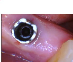 Pilier sur implant osseospeed 2 wlktak - Eugenol