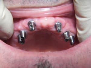 Piliers telescopique usinees en bouche yqcprr - Eugenol