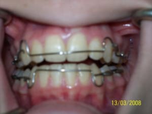 Plaque haut et bas dgiumy - Eugenol