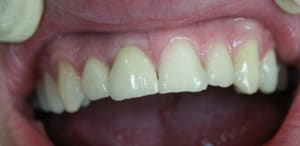 Postccm yrsftm - Eugenol