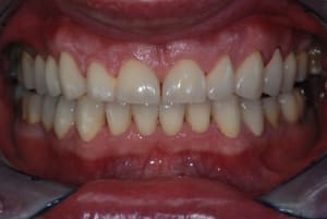 Post op cbv9vv - Eugenol