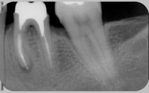 Post op ctdpvm - Eugenol