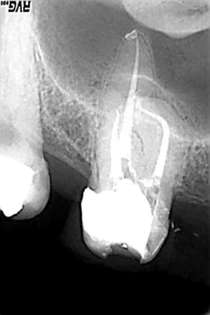 Post op d16 le 15 03 04 ohzugg - Eugenol