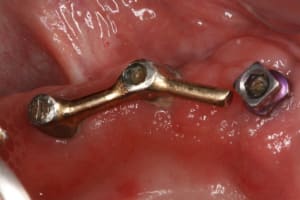 Pr  op  proth ses sur implants  haunt bas 002 ciygi2 - Eugenol