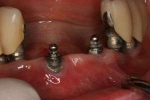 Pr op proth ses sur implants haunt bas 010 z5pwop - Eugenol