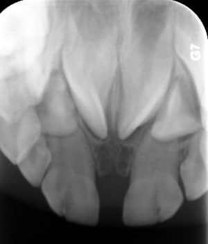 Preop d2btui - Eugenol