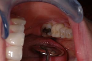 Preop dvmccl - Eugenol