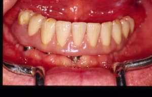 Prothèse bouche gqfcna - Eugenol