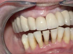 Prothèse conventionelle iztexa - Eugenol