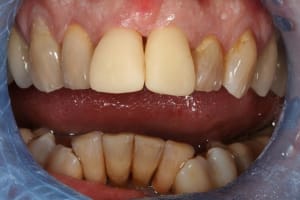 Provisoires w9xm9a - Eugenol