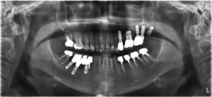 Quels implants jnnanc - Eugenol
