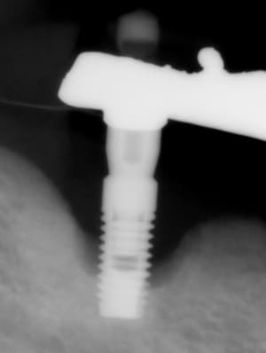 Radio periimplantite qamob6 - Eugenol