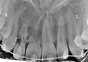 Resorption bh60ft - Eugenol