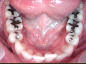 Scellement sillon pbiiau - Eugenol