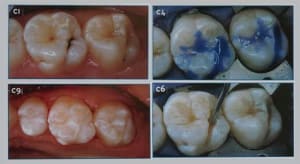 Sealant restauration wfhrdt - Eugenol