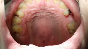 Secteur occlusal maxillaire jcdzni - Eugenol
