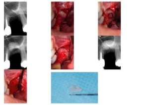 Sinus lift piezo vsdgq4 - Eugenol
