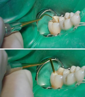Spatule titane jryfcv - Eugenol