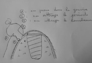 Suture dizk5d - Eugenol